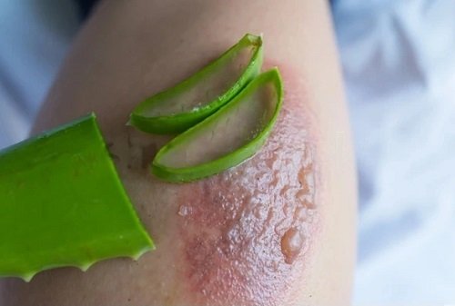 Amazing Facts All Aloe Plant Users Should Know scar Treatment